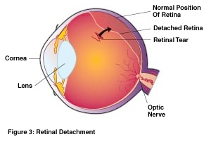 retina-3